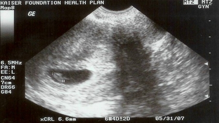 Ultrasound_small-2 Michelle Malkin: Ultrasound, The Anti-Science Left's Bugaboo Health  